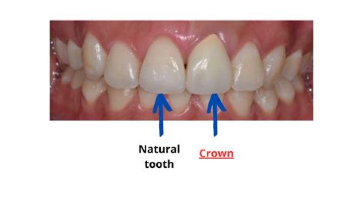 Are crowns better than teeth?