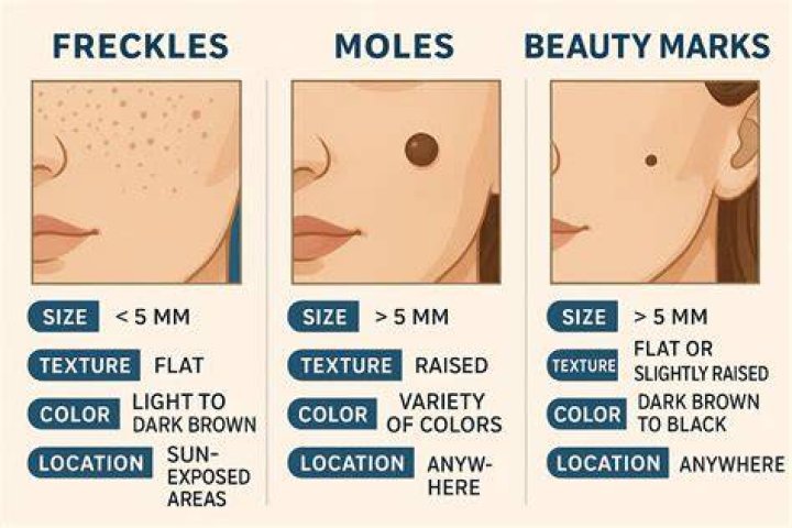 Are freckles beauty marks?