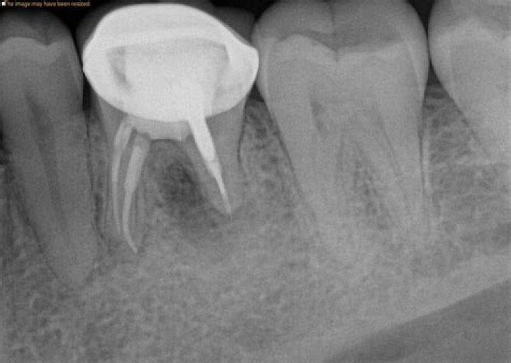 Can I pop a gum boil?