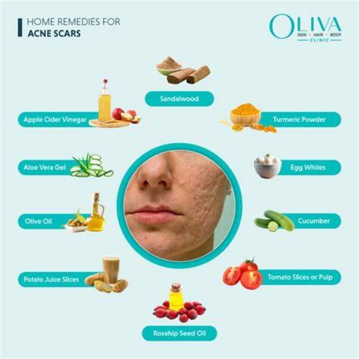 Can lemon cure acne?