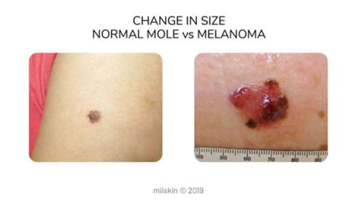 Can melanoma be non cancerous?