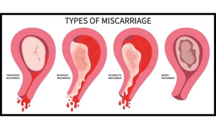 Can miscarriage cause bipolar?