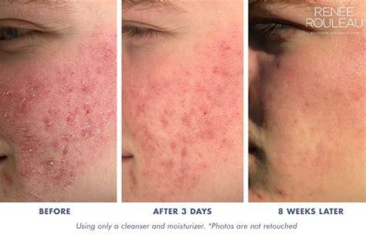 Can moisturizer cause pimples?