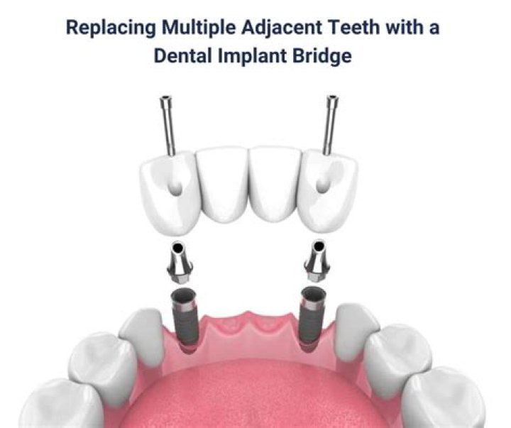 Can one implant hold 3 teeth?