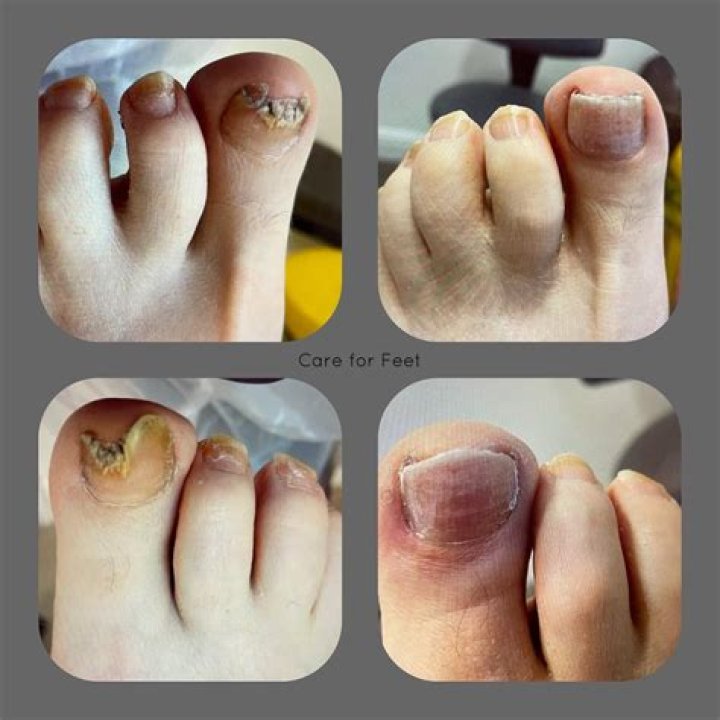 Can toenail fungus be cured permanently?