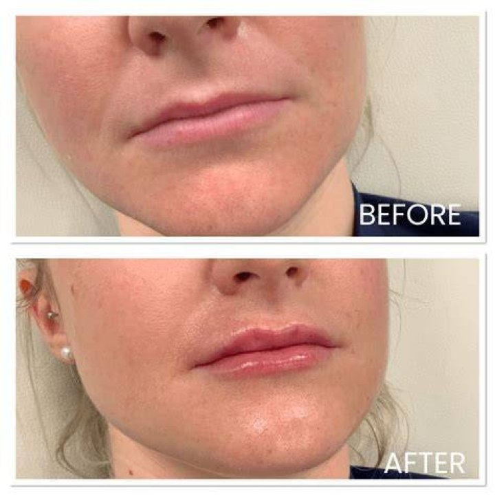 Can you get lip fillers at 16 UK?