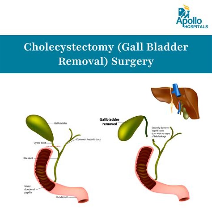 Can you have your gallbladder removed without being put to sleep?