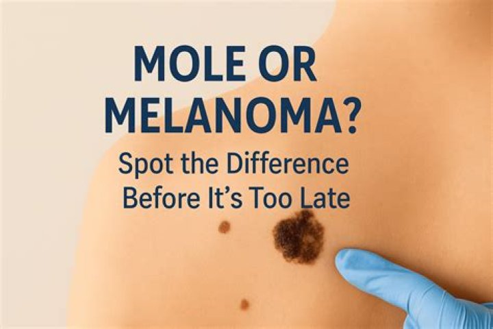 Can you pick a melanoma off?