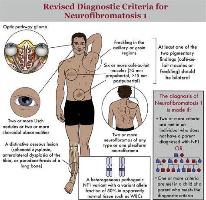 Can you prevent neurofibromatosis?