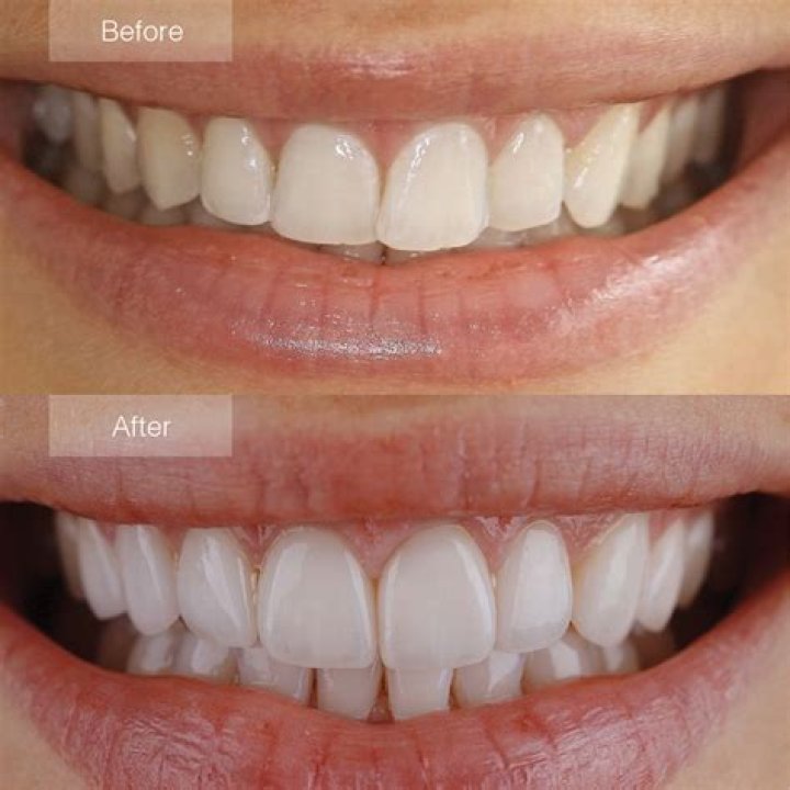 Can you whiten a veneer tooth?