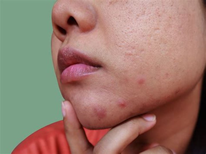 Do athletes have acne?