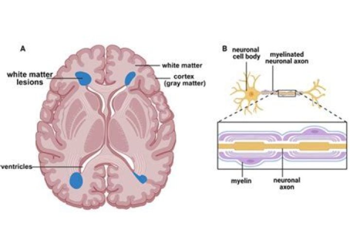 Do brain lesions always mean MS?