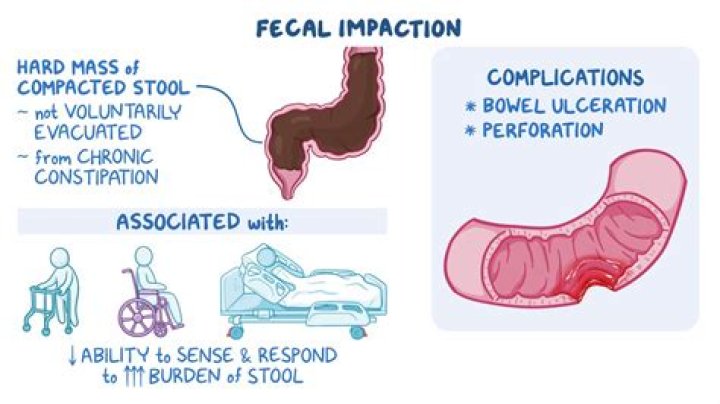 Do I have fecal impaction or just constipation?