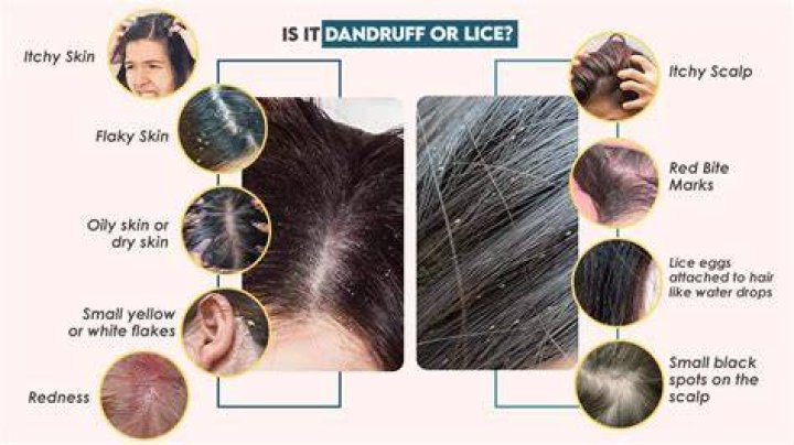 Do lice eat dandruff?