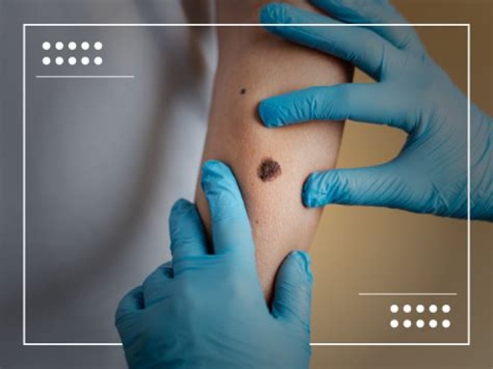Do melanomas hurt?