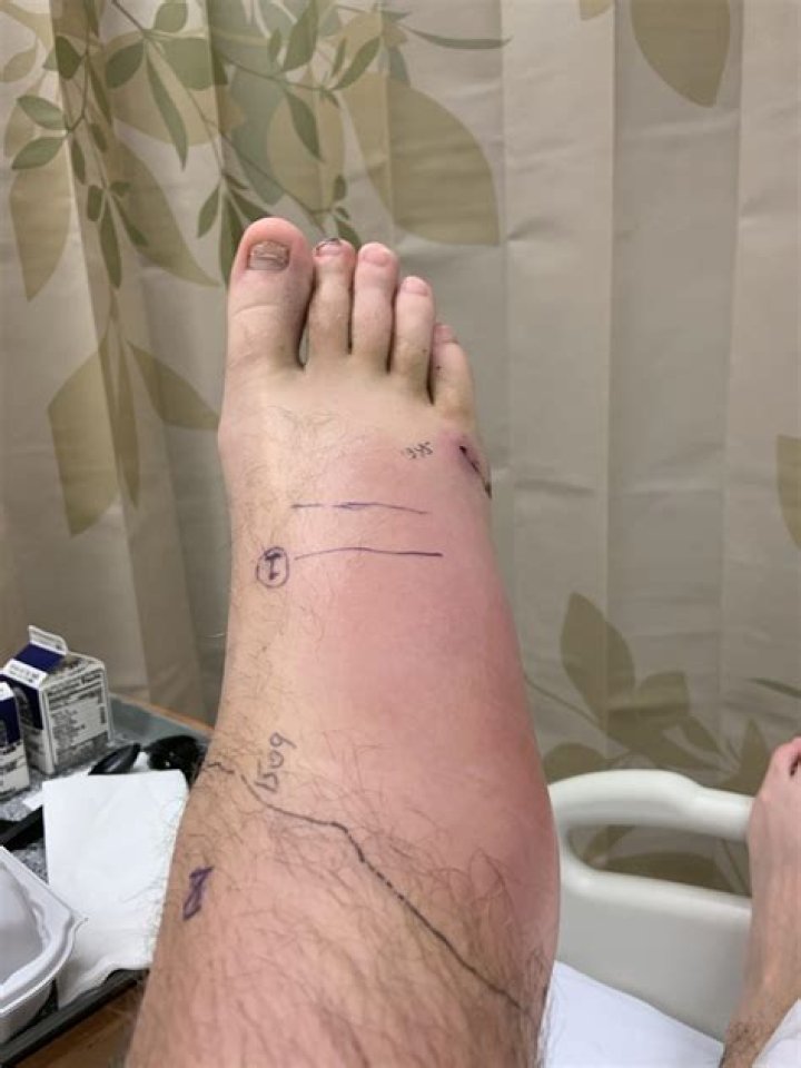 Do rattlesnake bites hurt?