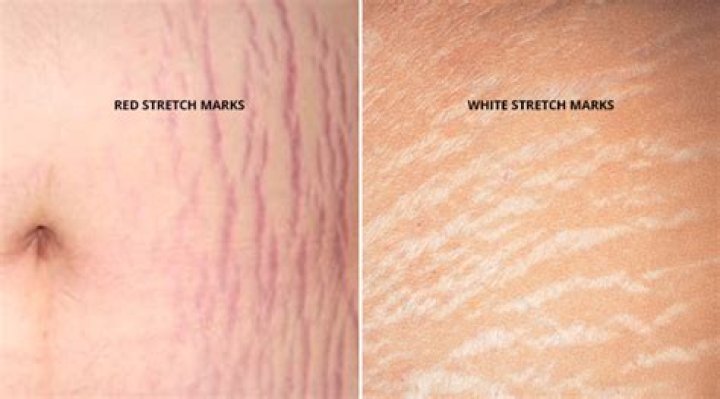 Do stretch marks eventually turn white?