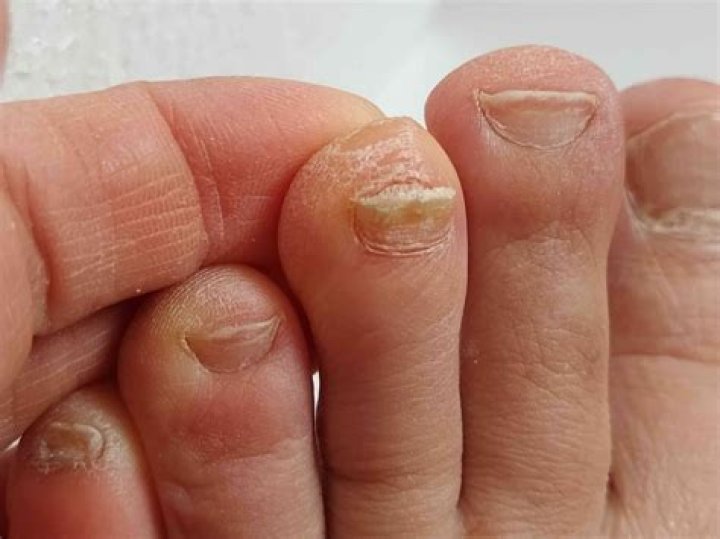 Do toenails get more brittle with age?