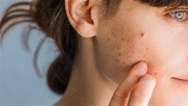 Does crying get rid of acne?