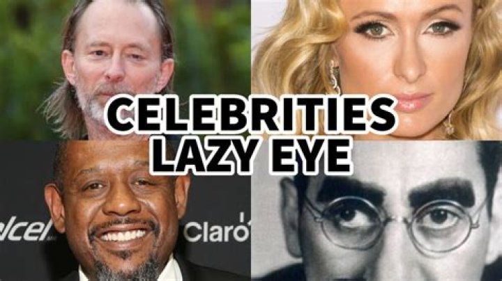 Does everyone have a lazy eye?