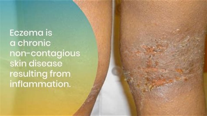 Does ice help with eczema?