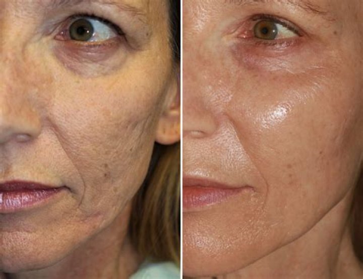 Does microneedling fade dark spots?
