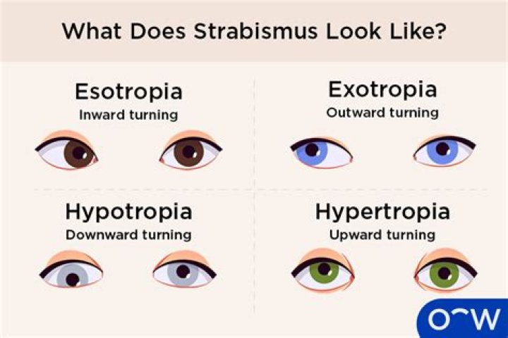 Does patching fix strabismus?