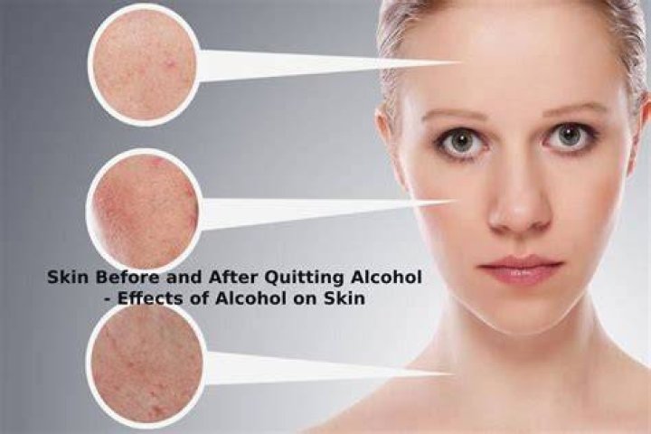 Does rubbing alcohol dry out skin?