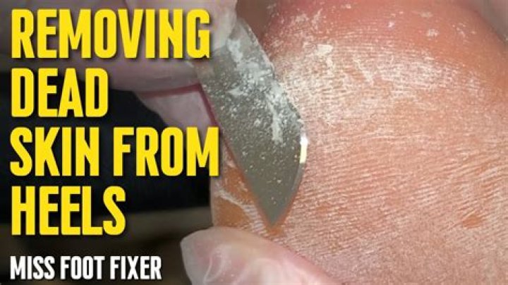 Does scraping your feet make them worse?
