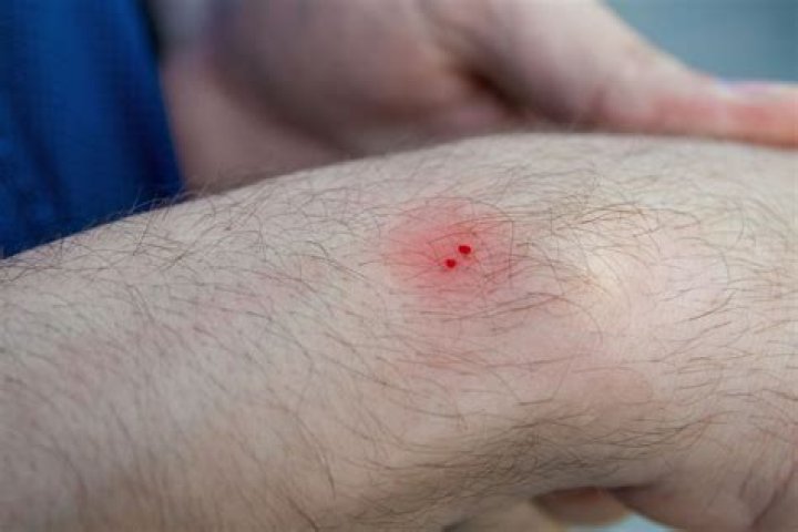 Does snake bite pain?