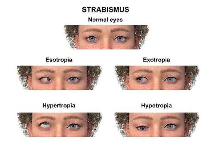 Does strabismus cause head tilt?