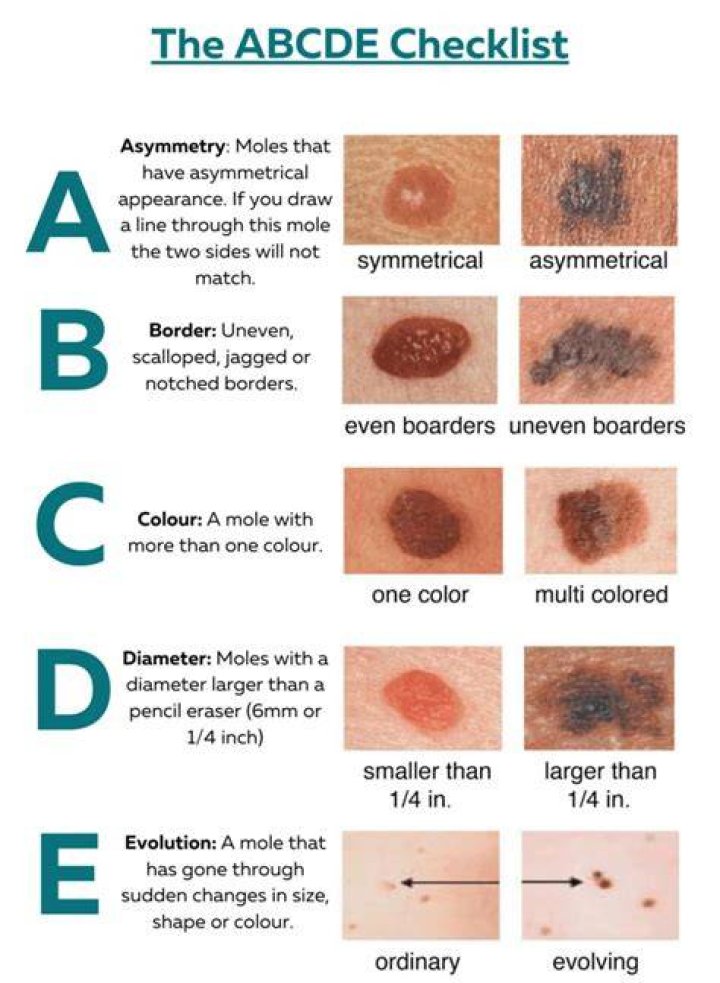 How can you tell if a mole is cancerous?