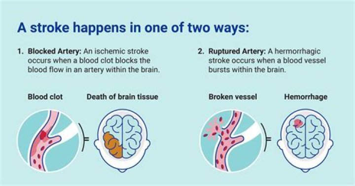 How can you tell the difference between a stroke and a stroke mimic?