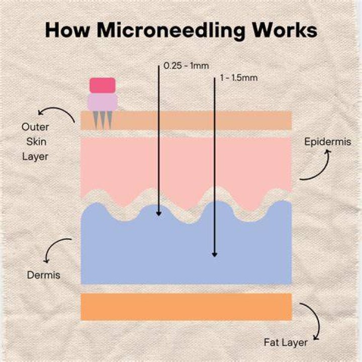 How deep should you go with microneedling?