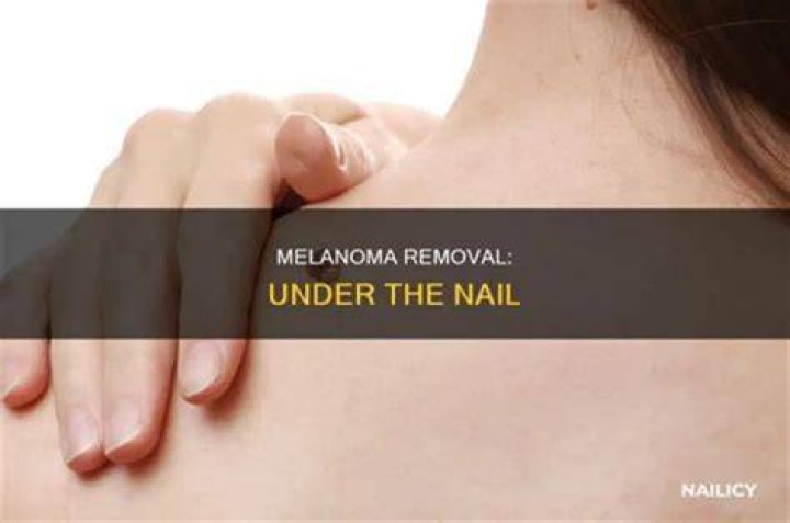 How do they remove a melanoma?