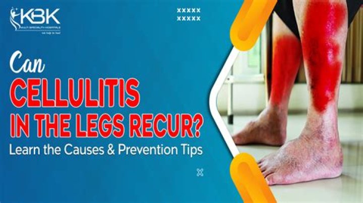 How do you get rid of cellulitis on legs?