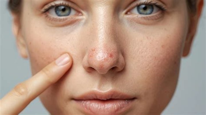 How do you reduce the redness of a burn scar?