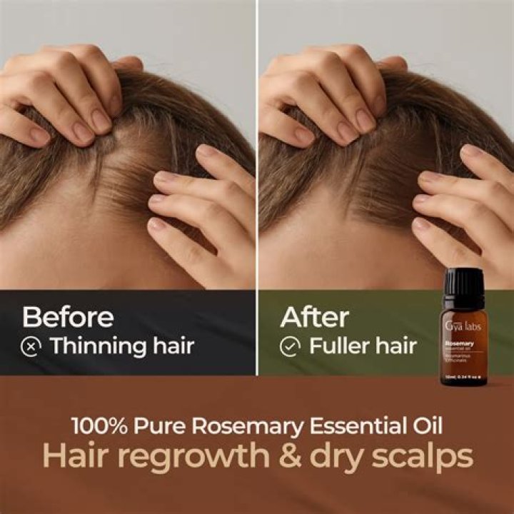 How do you use rosemary oil for baldness?