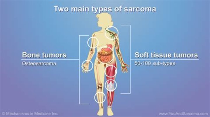 How does a sarcoma feel?