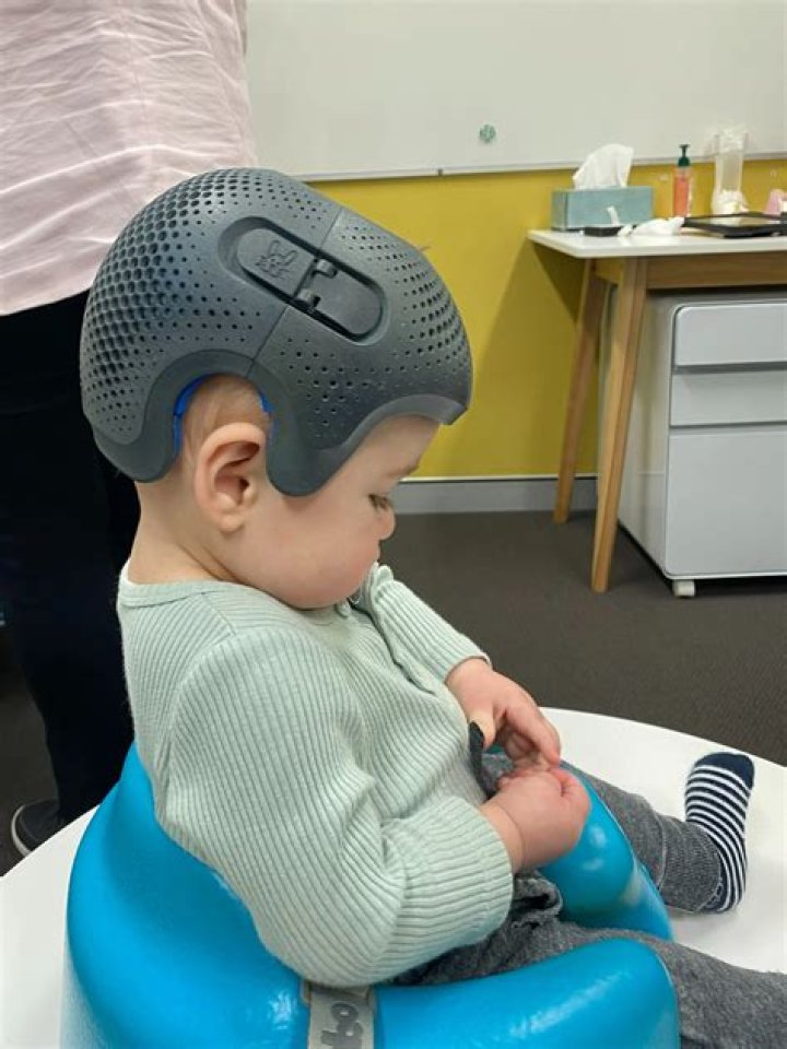 How long does helmet therapy take?