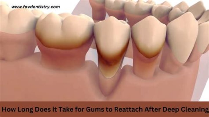 How long does it take for gums to reattach after deep cleaning?