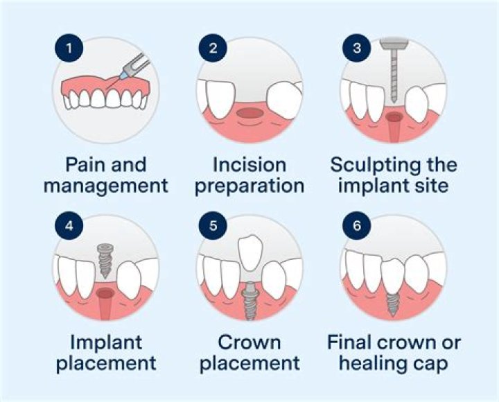 How long is recovery for tooth implant?