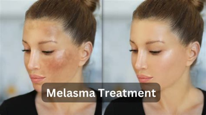 How often do dermatologists miss melanoma?