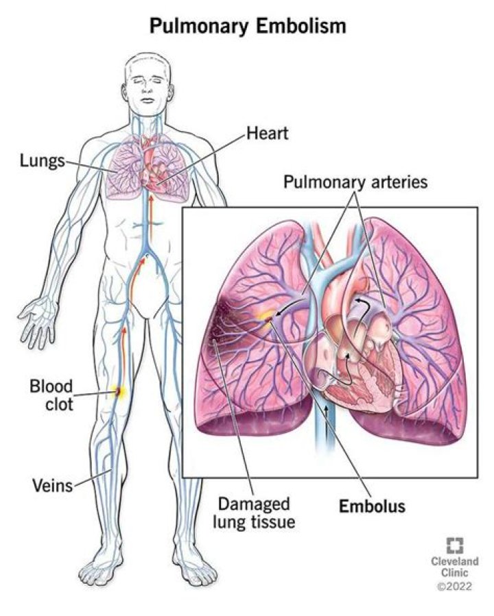 How painful are pulmonary embolisms?