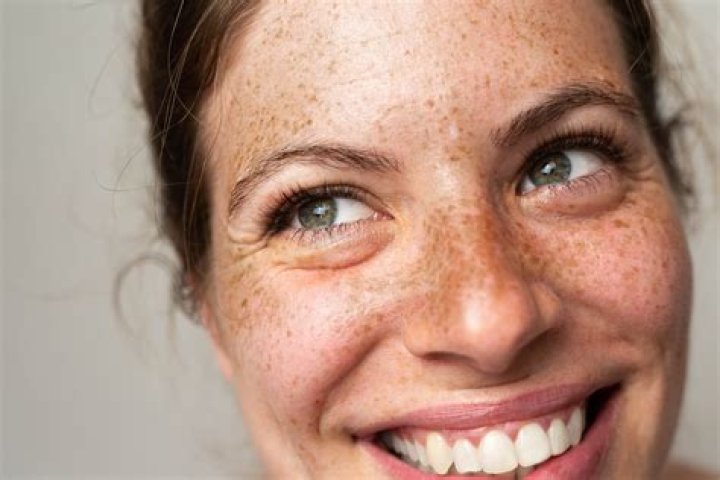 Is a birthmark a freckle?