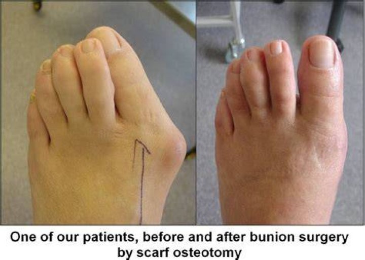 Is bunion surgery worth having?