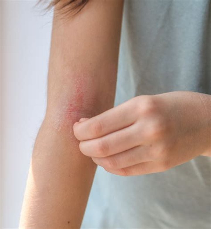 Is eczema gut related?