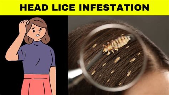 Is it possible to have lice for years?