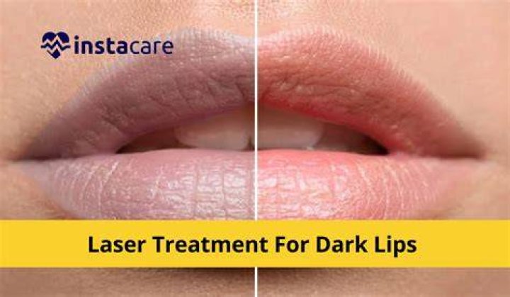 Is there laser treatment for dark lips?