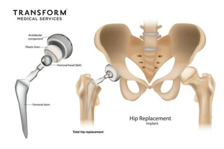 Is walking good if you need a hip replacement?